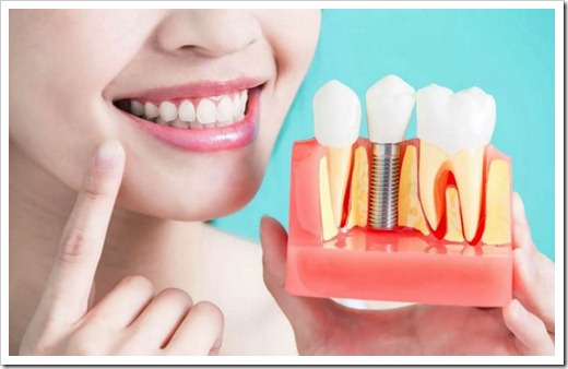 Различные виды имплантации зубов 