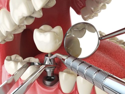 Как делают имплантацию зубов 