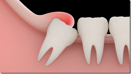 Удаление зуба мудрости: основные характеристики процедуры